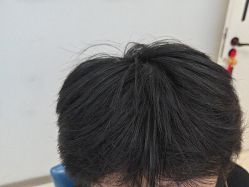 -大麦微针植发丨全国连锁