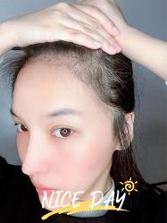 -大麦微针植发全国连锁