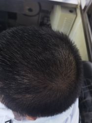 点击看大图 -碧莲盛·不剃发植发