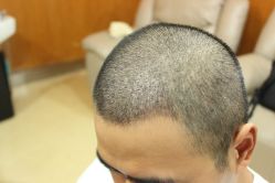 点击看大图 -大麦微针植发丨全国连锁