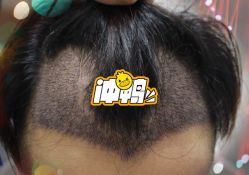 -大麦微针植发全国连锁