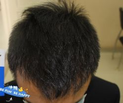 -大麦微针植发丨全国连锁