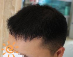 -大麦微针植发丨全国连锁