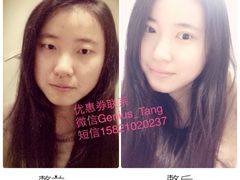对比图，双眼皮精神了很多-上海华安整形外科门诊部
