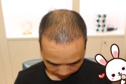 -大麦微针植发丨全国连锁