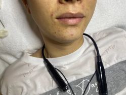 -苗方清颜专业祛痘