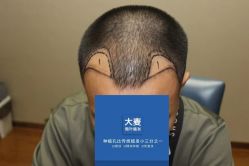 -大麦微针植发全国连锁