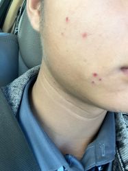 -悟空祛痘·诺奖技术专业店