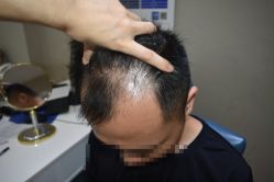 点击看大图 体验前-大麦微针植发全国连锁