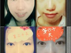 两个月-上海华安整形外科门诊部