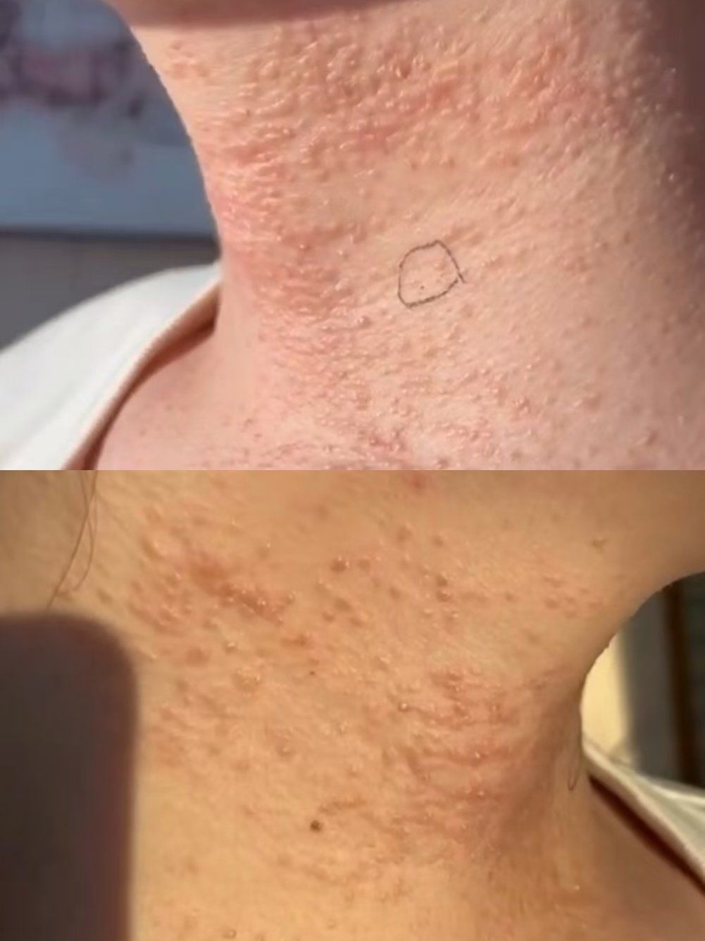 汗管瘤\n汗腺堵塞引起的汗腺增生\n终身无法自行修复,自行消失!