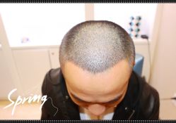 体验后-大麦微针植发全国连锁