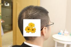 -大麦微针植发丨全国连锁