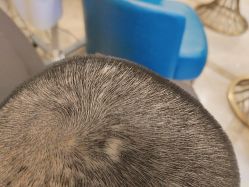 -碧莲盛·不剃发植发