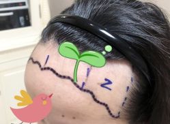 -大麦微针植发全国连锁