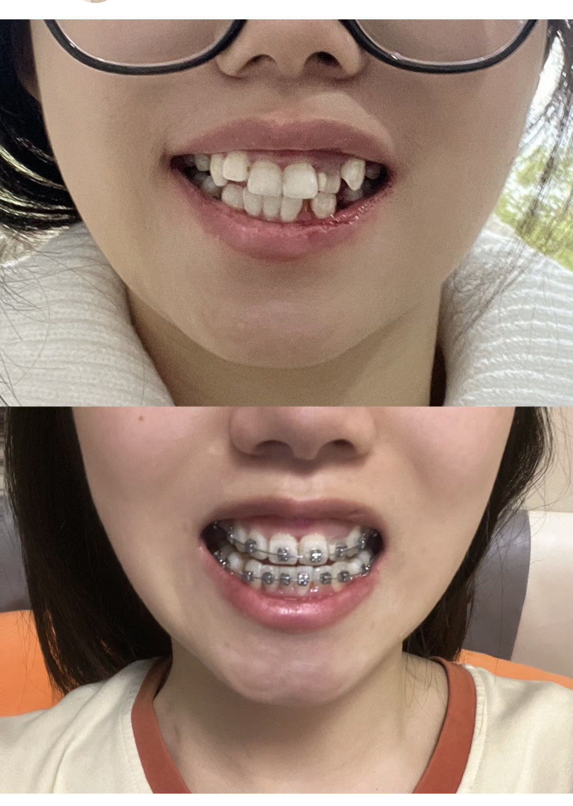 矫正牙齿后半年变化!