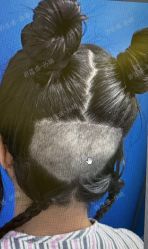 -碧莲盛·不剃发植发