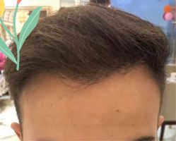 点击看大图 -大麦微针植发全国连锁