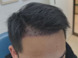 -大麦微针植发丨全国连锁