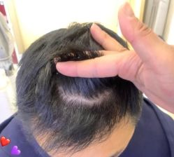 -大麦微针植发丨全国连锁