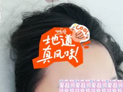 -大麦微针植发全国连锁