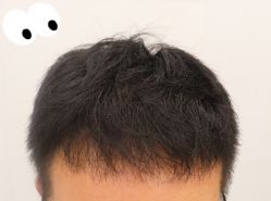 -大麦微针植发全国连锁