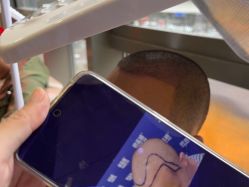 -碧莲盛·不剃发植发