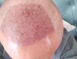 -雍禾植发全国连锁