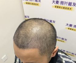 -大麦微针植发全国连锁