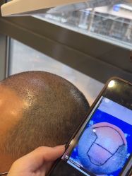 -碧莲盛·不剃发植发