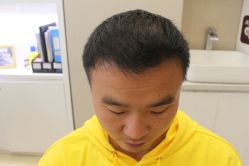 点击看大图 -大麦微针植发丨全国连锁