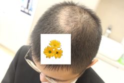-大麦微针植发丨全国连锁
