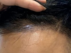 体验后-雍禾植发全国连锁