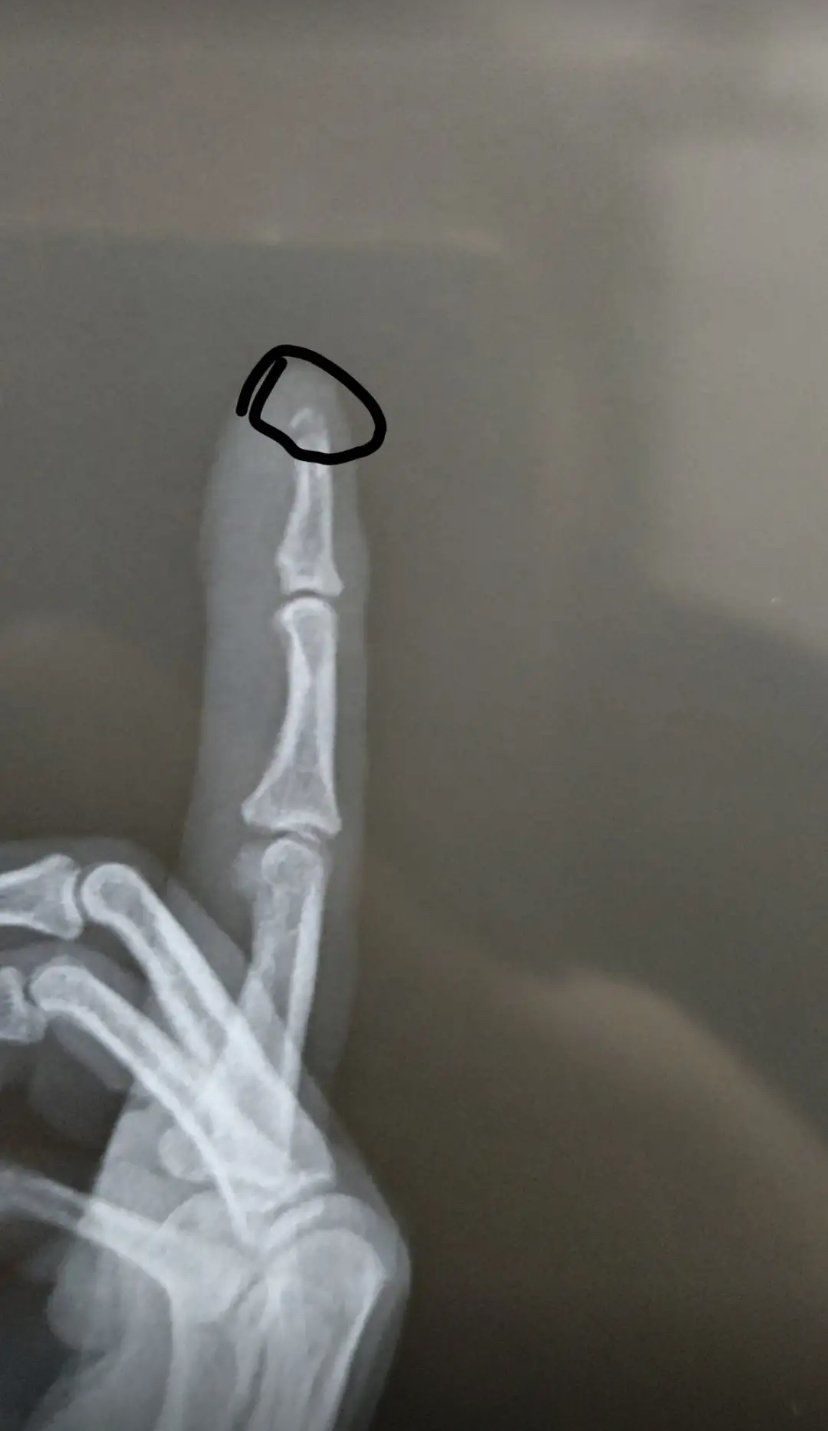 指尖骨头断了,手指骨裂,带薪休假一个月,跟医药费,有懂的可以说说吗?