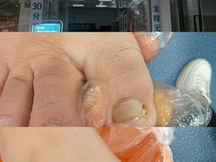 -新甲连锁灰指甲·甲沟炎·修脚(爱联店)