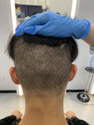 -大麦微针植发全国连锁