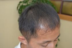 -大麦微针植发丨全国连锁