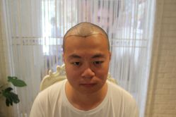 点击看大图 -大麦微针植发丨全国连锁