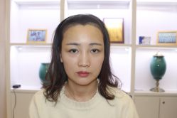 -大麦微针植发丨全国连锁