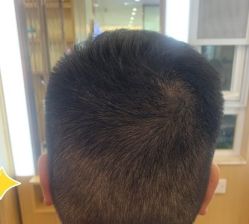 -大麦微针植发丨全国连锁