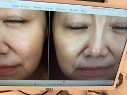 -苑苑vbeauty科技美容SPA