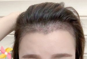 -大麦微针植发丨全国连锁