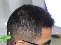 -大麦微针植发丨全国连锁