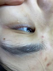 体验前-爱莎扁平疣·汗管瘤·斑痣中心