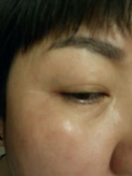 点击看大图 眉毛和美瞳线做完十天,提斑刚做完当时拍的-北京英煌医疗美容