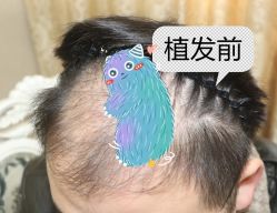 -大麦微针植发全国连锁