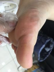 -德哥灰指甲脚气甲沟炎跖疣护理