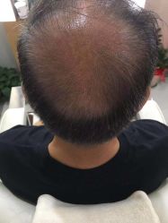 -大麦微针植发全国连锁