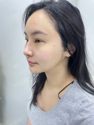 -海涛医疗美容·面部抗衰·注射美鼻