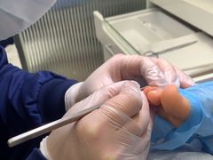 -Andrew指甲专科灰指甲·甲沟炎矫正·3D步态矫形鞋垫定制(浦三路店)